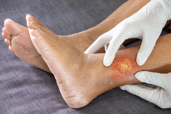 chronic wound treatment in upland, ca