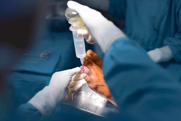 debridement (removal of dead tissue) in upland, ca
