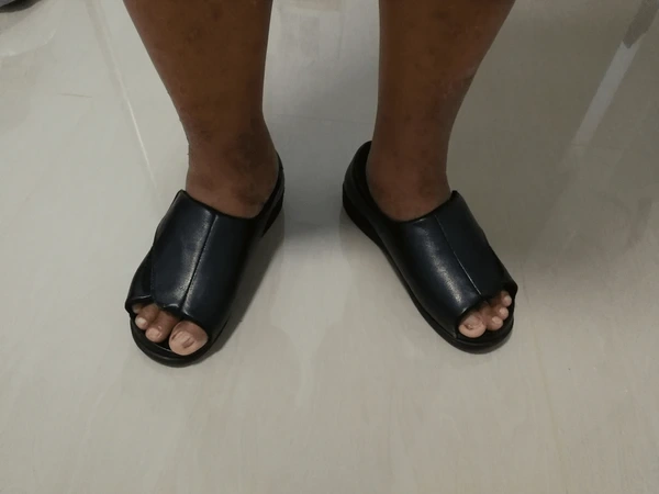 diabetic foot ulcer care in upland, ca