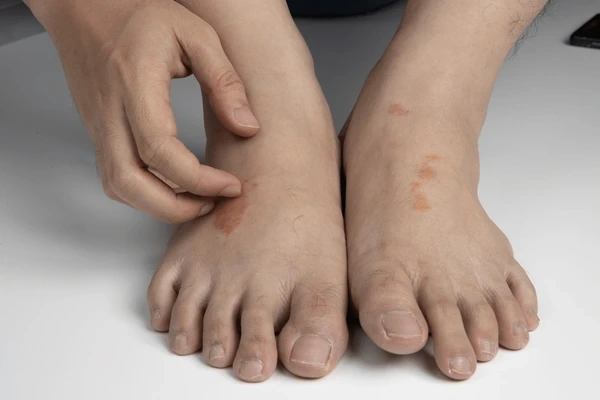 foot infection treatment in upland, ca