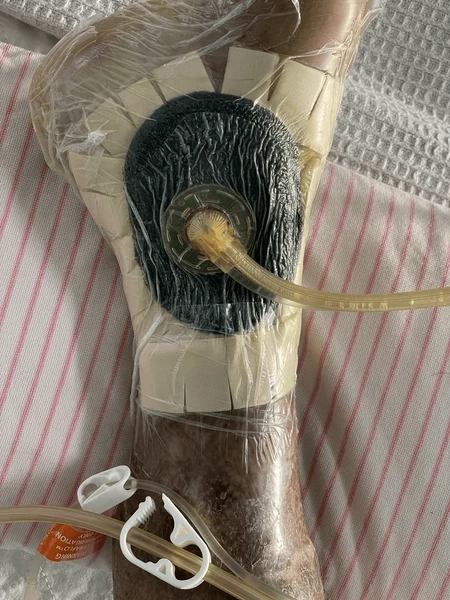 negative pressure wound therapy (wound vac) near you