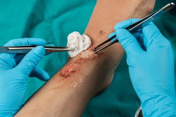 venous leg ulcer treatment in upland, ca