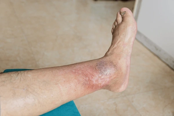 venous leg ulcer treatment near you